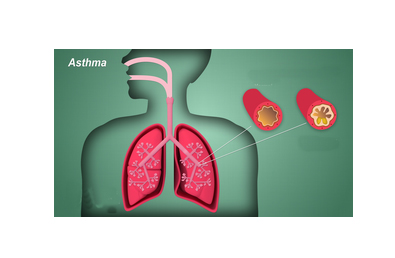 'IDIOT' syndrome hampers asthma treatment — Experts