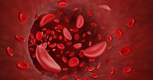 Sickle Cell