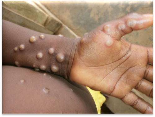 monkeypox